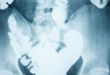 Bowel cancer screening age to be lowered to 50 in England – UK