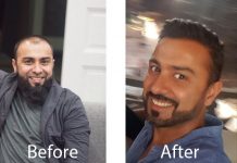 Want Hair: One-Stop Destination for Your Hair Transplant Needs in the UK Want Hair: One-Stop Destination for Your Hair Transplant Needs in the UK